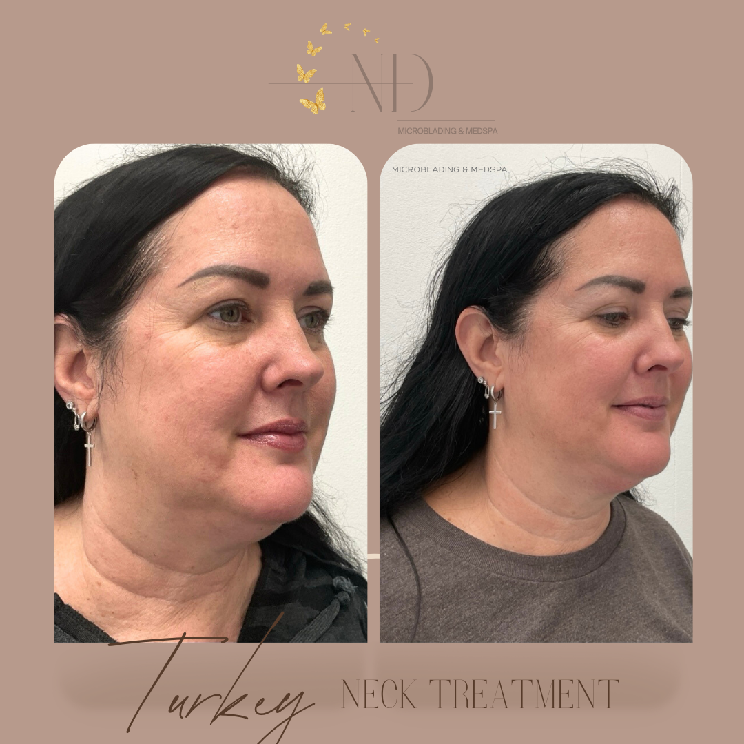 Non-Invasive Facelift — Neck