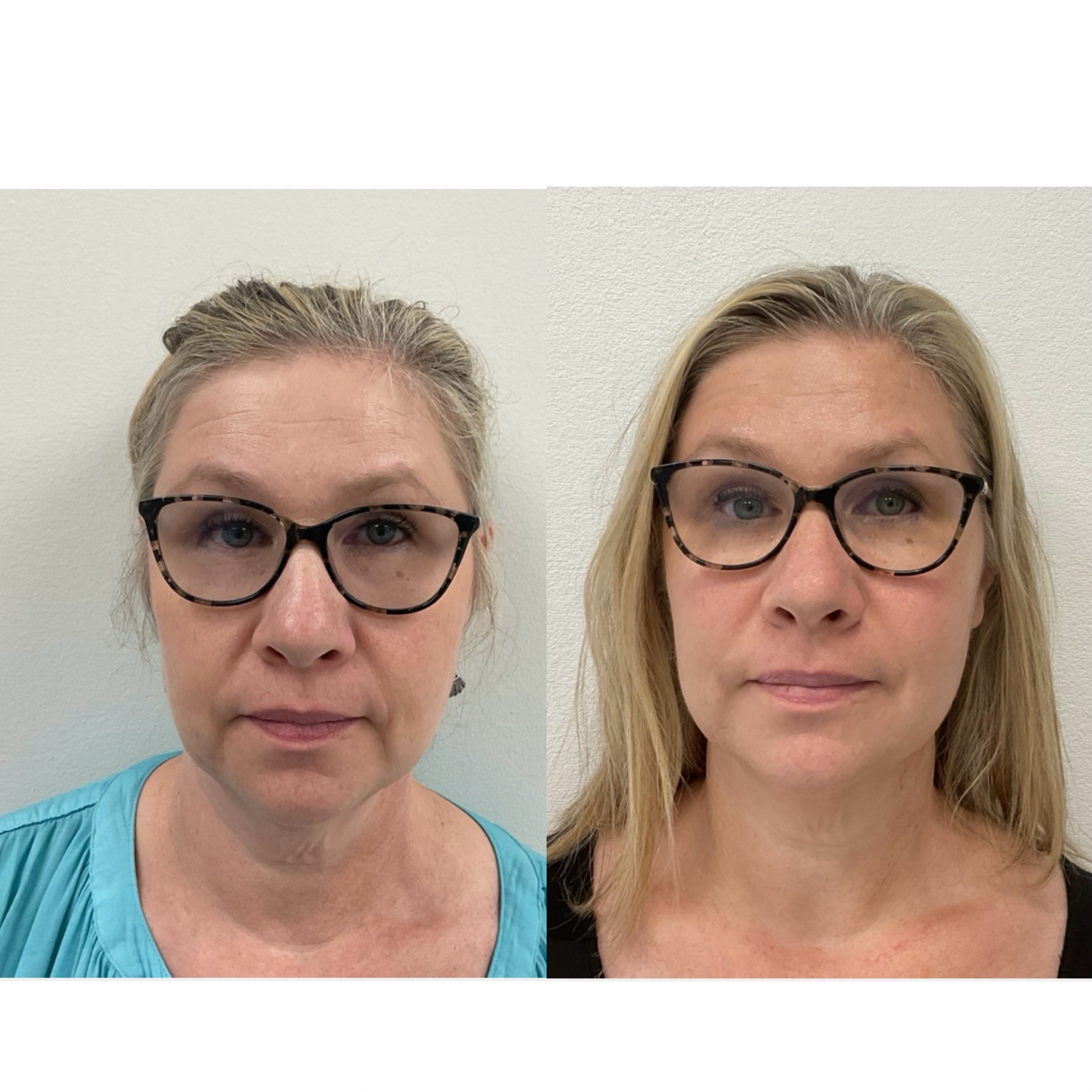 Facial Rejuvenation Result