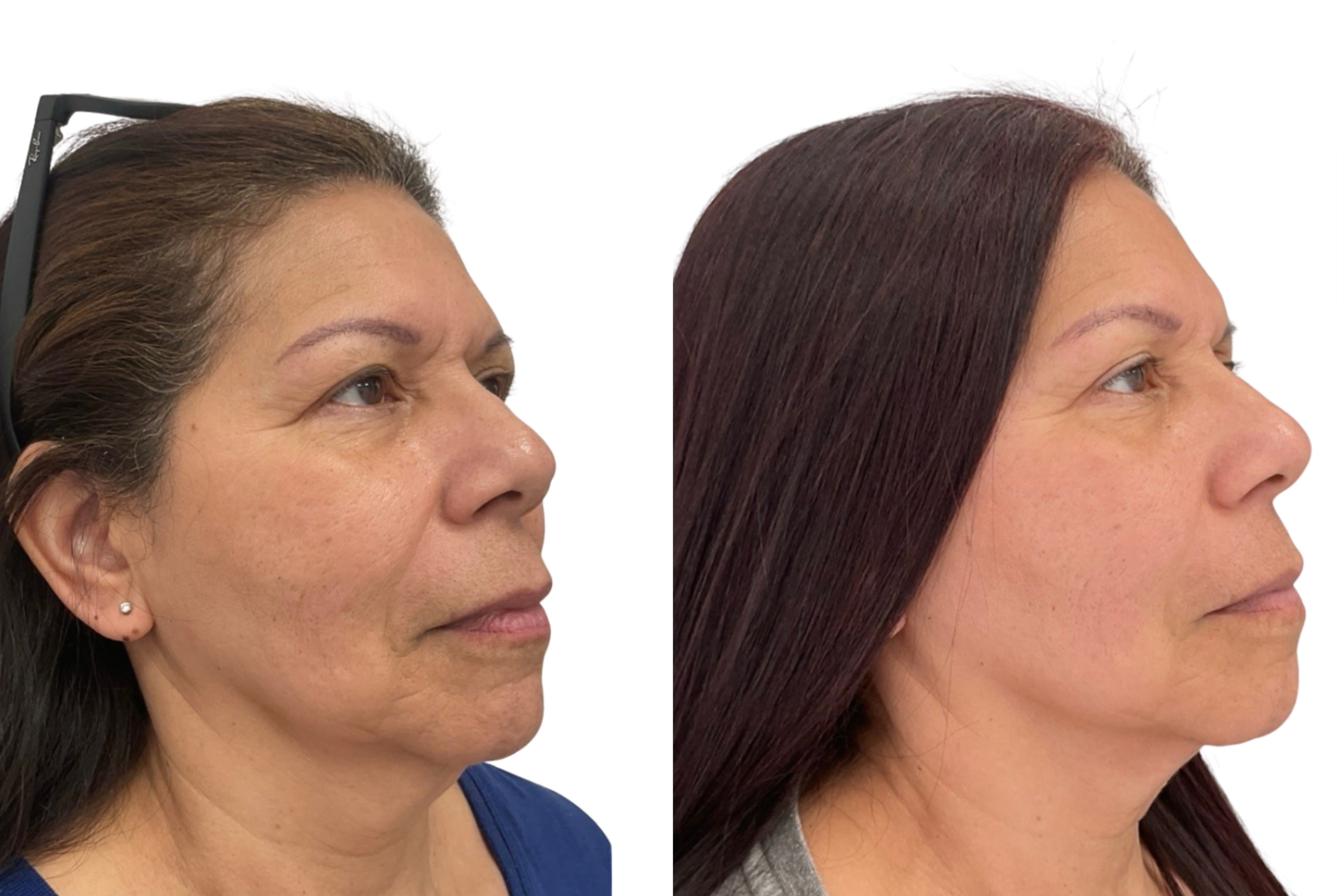 Facial Rejuvenation Before & After