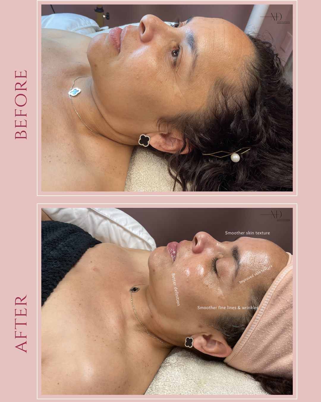 She Didn't Get Filler — Result
